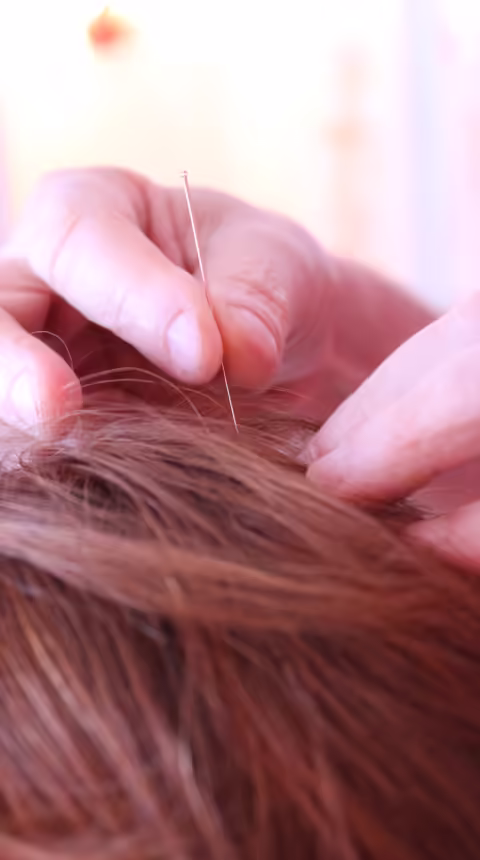 Acupuntura Aplicada Cabeça