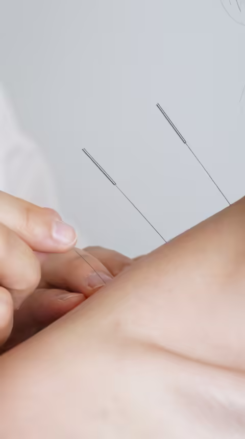 Acupuntura Ombro